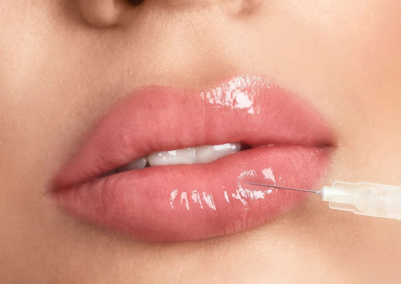 Natural-looking result after a dermal filler treatment