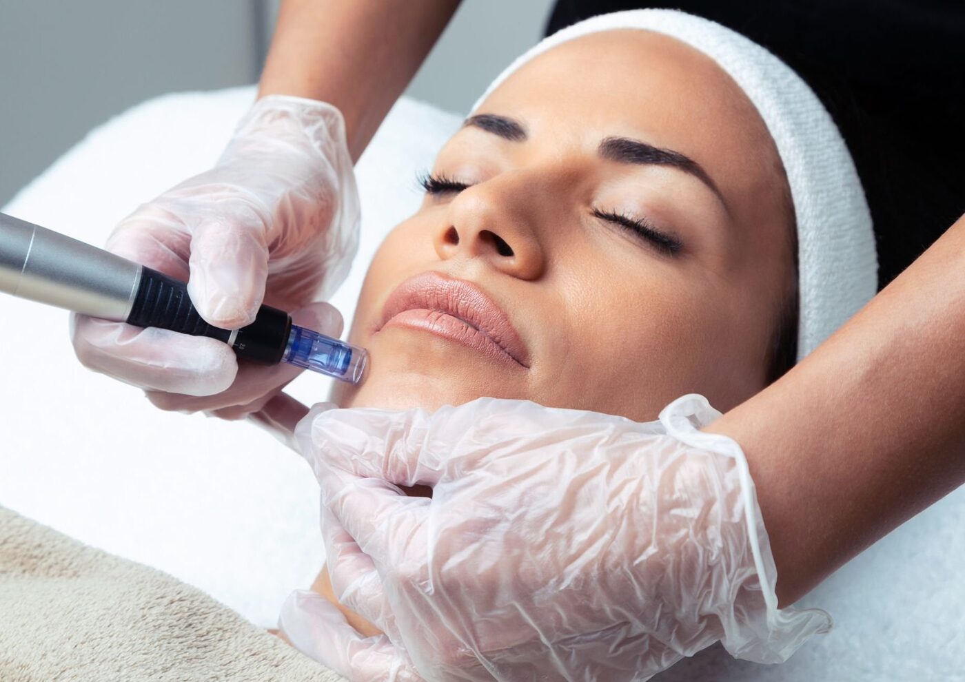 Polyneedling treatment,skin regeneration and rejuvenation